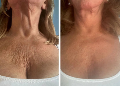 Silikonski obliž proti gubam na prsih